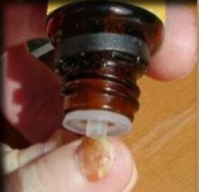 Kapanje kapljic na noht na nogi z glivicami