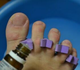 Priprava na zdravljenje nohtov s protiglivičnimi kapljicami